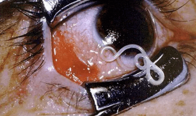 Tipi di parassiti nel corpo umano